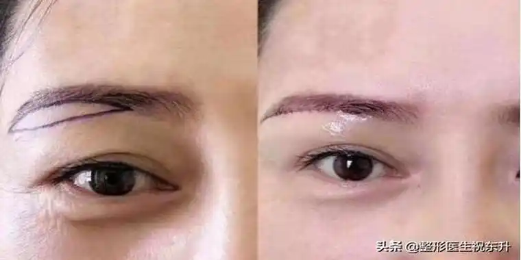 切眉会不会影响面部风水(想做"提眉手术"的人)