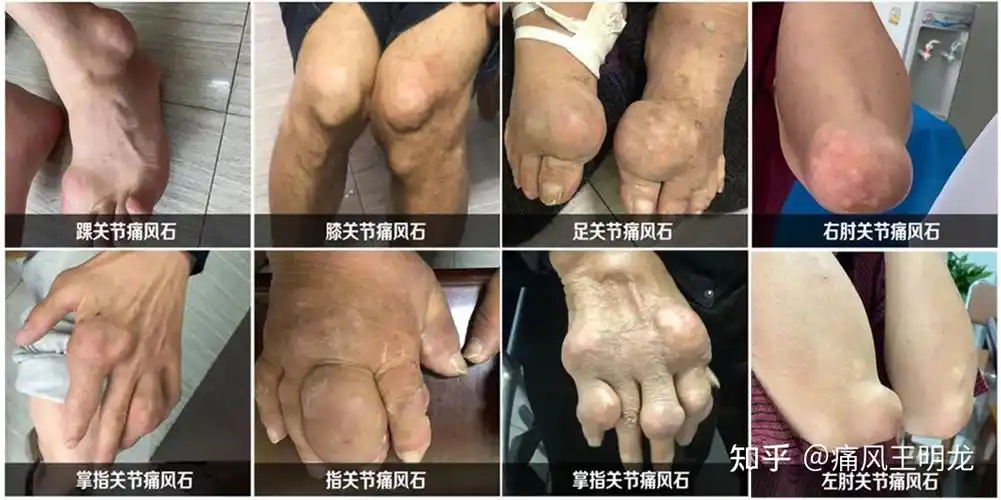 左脚无名脚趾肿痛是痛风吗? - 知乎