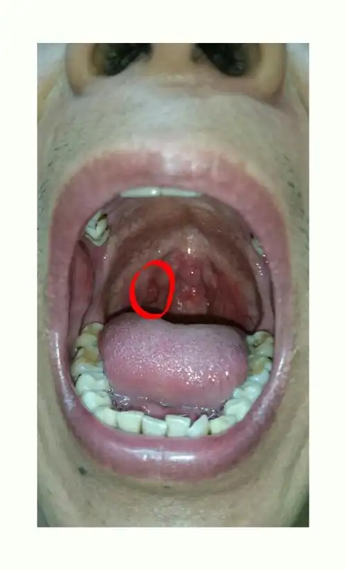 男,34岁,有19年烟龄,我在戒烟3个月后喉咙,扁桃体旁边长出了这样一个