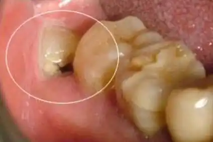 当然不能!当出现牙龈肿痛,智齿处经常发炎的时候,别犹豫,拔,以绝后患!