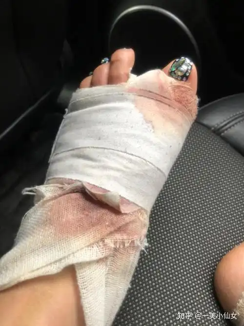 拇趾外翻怎么办?只能通过手术矫正吗?