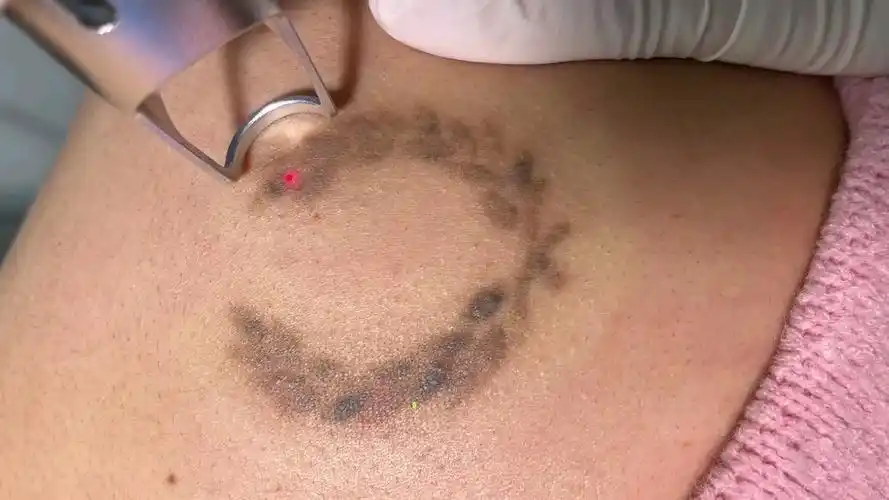 纹身清洗第二次