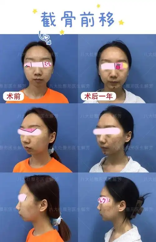 下巴截骨前移术来解决,对于那些前移程度小于10mm的,其实通过假体或者