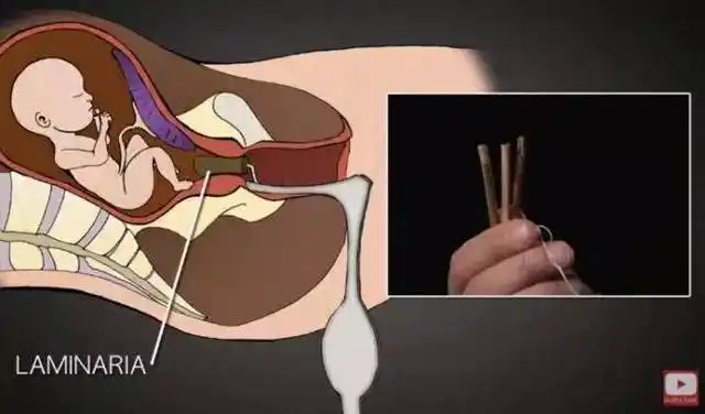 bbc:帮人堕胎1200次后 他辞了职 说出了残忍的真相