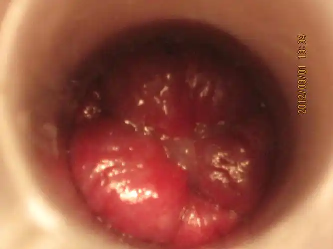 第二十六例环状静脉曲张混合痔陈术前术中术后图