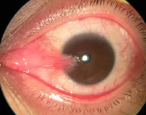 翼状胬肉一定要手术吗?听说术后容易复发?_眼科