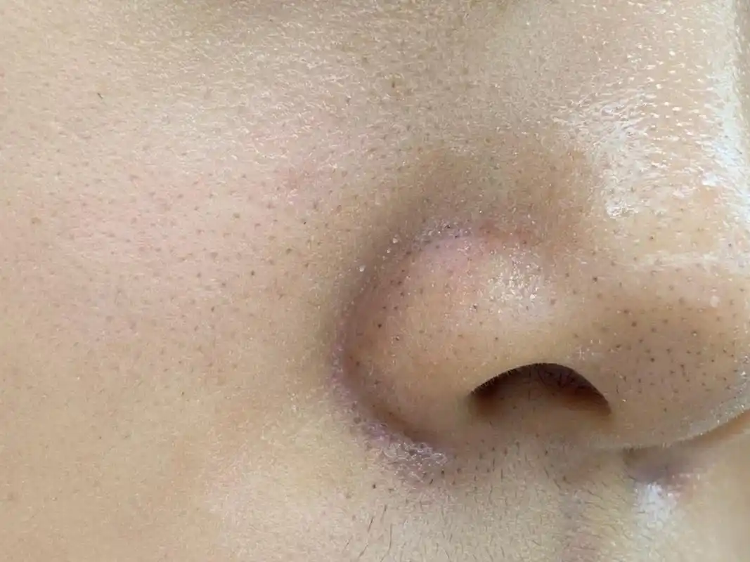 战痘宣颜丨如何通过医美方式祛除黑头,让你变得更美