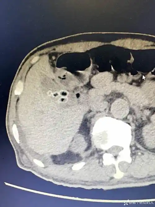 ct下胆囊的"空心"结石