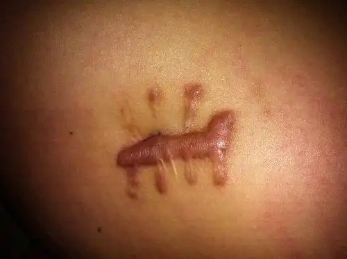 手术后疤痕凸起,外科医生请近!