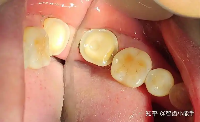 全覆盖高嵌体一例分享