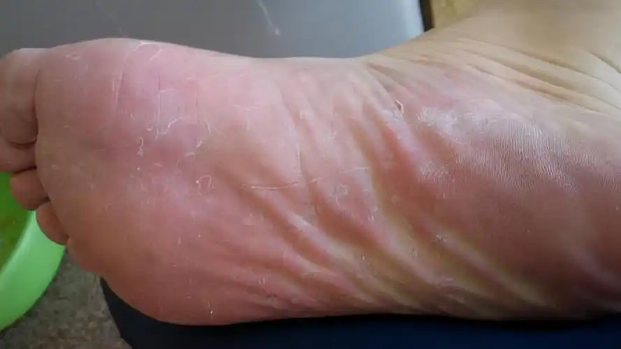 脚总是脱皮还痒怎么办(如何避免真菌感染呢)