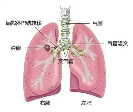 肺癌为何是第一大癌症什么原因导致肺癌医生说清楚