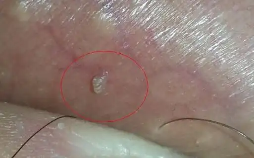 尖锐湿疣感染男性群体时,其病变好发于男性的龟头,尿道,包皮及系带