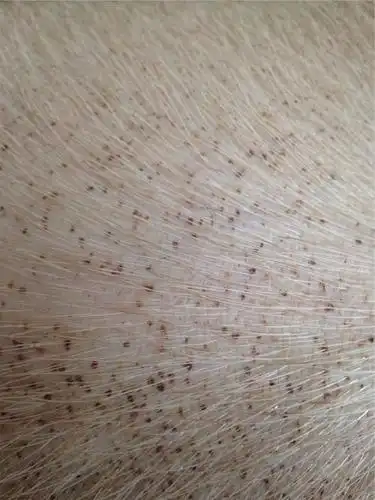 白血病可以报销多少 白血病成都社保