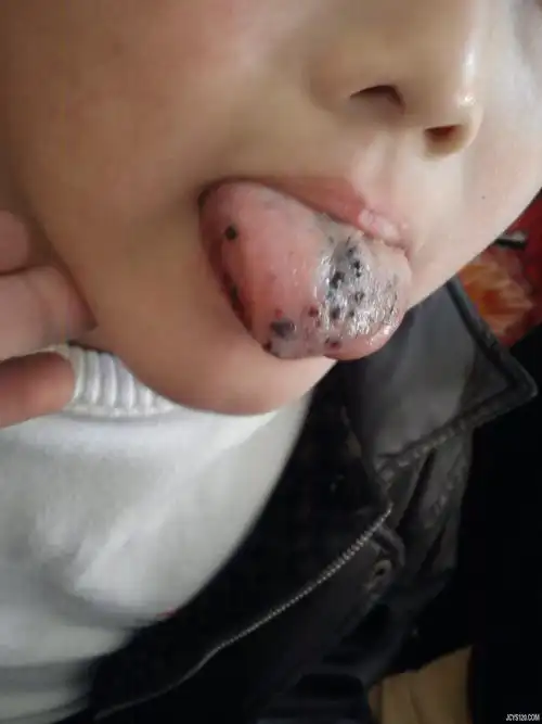10岁小孩舌炎. 儿科讨论版 基层医生论坛