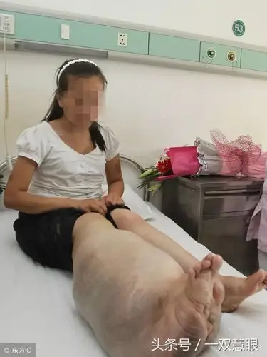 安阳22岁姑娘腿比腰还粗被锯断后她感恩所有人