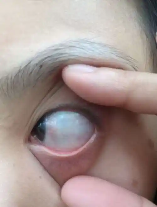 非常常见的睑裂斑