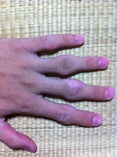 手指关节突出.因为几年前有折手指的习惯.后来渐渐的就肿大了.