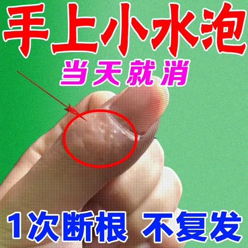 汗孢疹汗状孢疹手指上起小水泡汗泡孢疹乾裂脱皮止痒专用