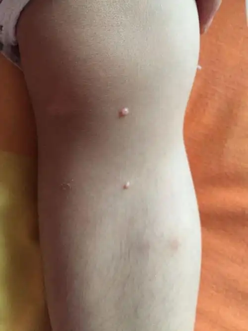三岁半宝宝腿上长了两个白色透明的小包,不痛不痒的,腋下也有几个类似