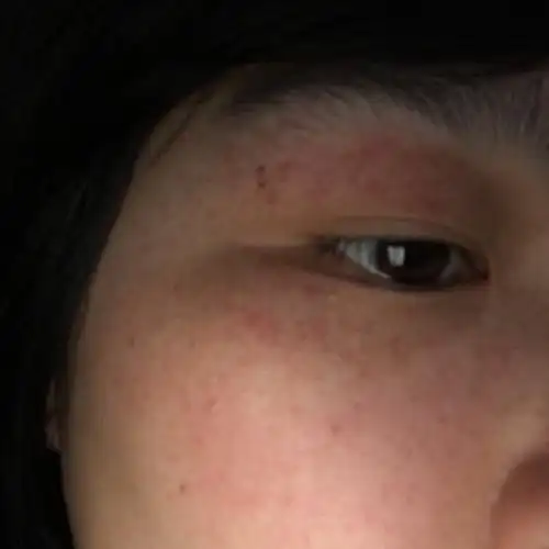 眼睛上下眼皮突然长了好多红点点