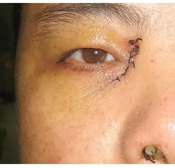 鼻内窥镜泪囊鼻腔吻合术让你告别"林妹妹"