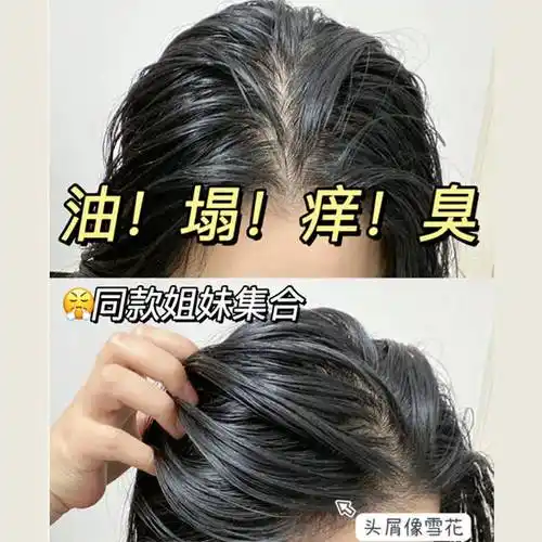 去屑洗发水伤头发吗去头屑去油最好的洗发水排行榜