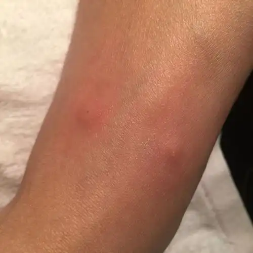 这是什么虫子咬的 我穿着跑鞋都被咬 已经好几天了第二次肿起来很痒