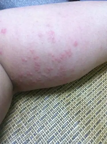 这是荨麻疹还是湿疹,在小腿弯处,特别痒,怎么办