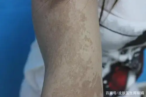 常见咖啡斑治疗案例解析与延伸阅读