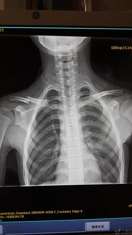 14岁男孩的锁骨骨折,保守10天后移位,继续保守还是手术呢?