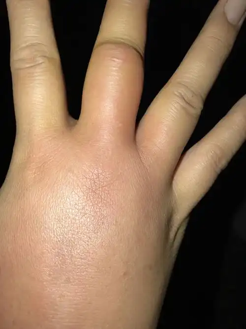 手指在河里被扎了结果回家开始发肿发胀顺着淋巴线往上发肿,现在已经