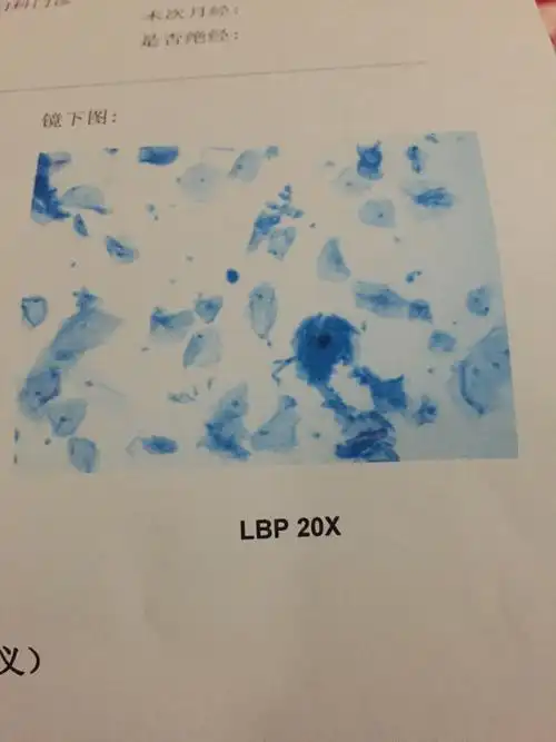 hpv39 58 68阳性 tct非典型鳞状上皮细胞(不能明确其意义) 下周准备