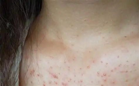 肝病身上起红疙瘩图片 肝硬化患者身上起红疙瘩怎么回事