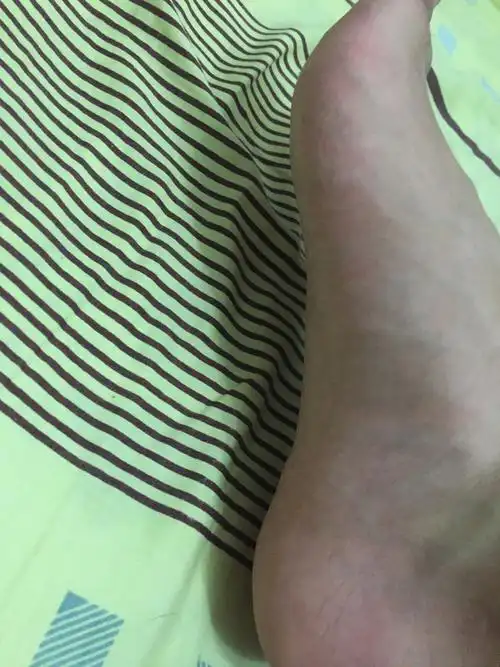 请问我这是扁平足吗,走路的时候感觉整个脚掌着地,有时候有点疼.