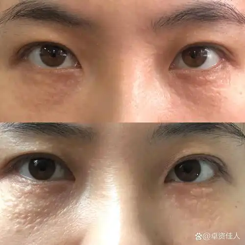 汗管瘤激光一个月