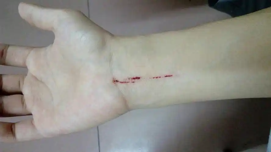 手腕被罐头的拉环划伤,现在最纠结的问题是要不要打破伤风?