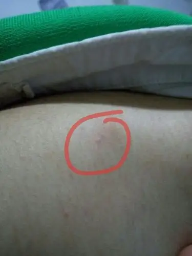 肩膀上长了个小疙瘩.