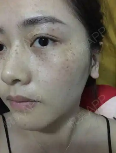 结痂全掉了!脸也从来没这么干净过!太爽了!祛斑_悦美整形