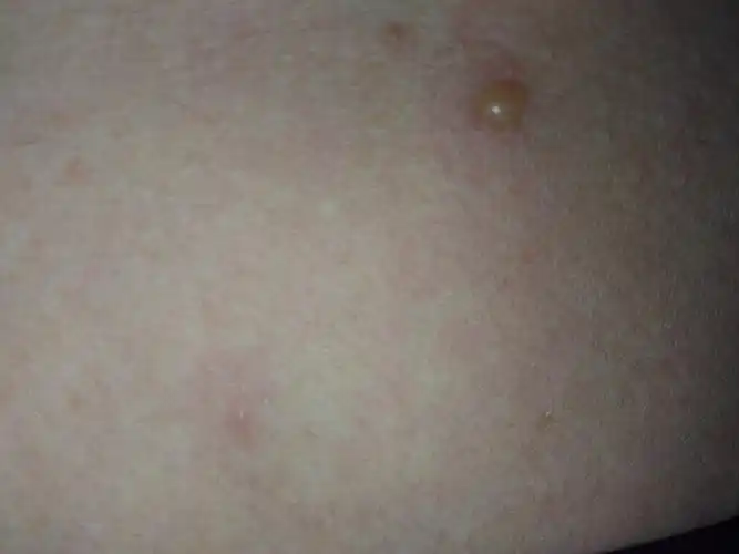 全身起满了透明的小泡泡,头皮也是,很痒是怎么回事