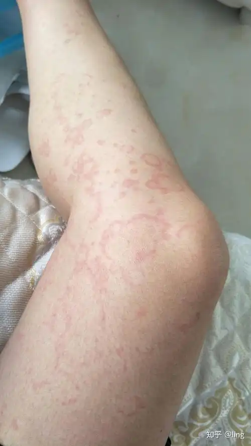 大半夜荨麻疹发作,超吓人