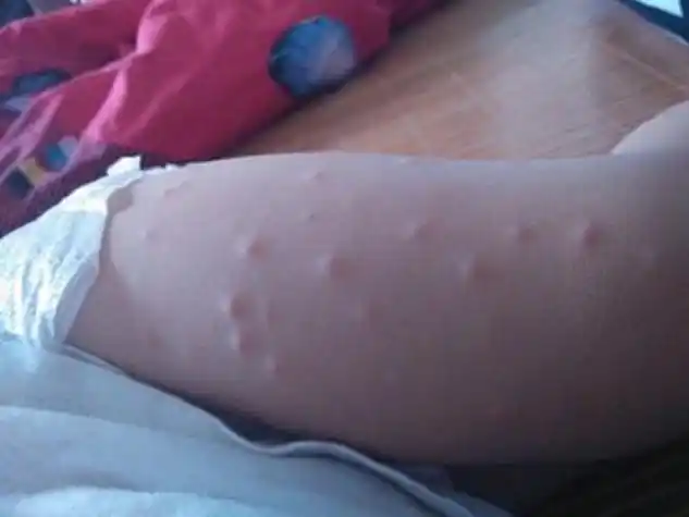 丘疹性荨麻疹图片_丘疹性荨麻疹症状表现图片大全_有来医生