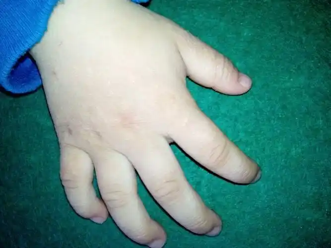 小孩子手上长疙瘩