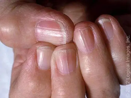 宝宝指甲月牙少有白点有小坑都是怎么回事