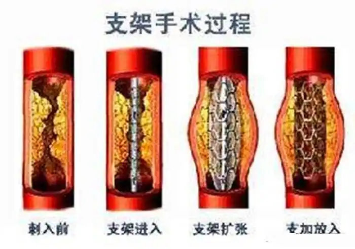 既然血管支架能穿进人的血管,为何不直接用支架把血管里的血栓吸出来?