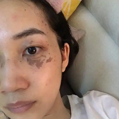 褐青色痣第六天