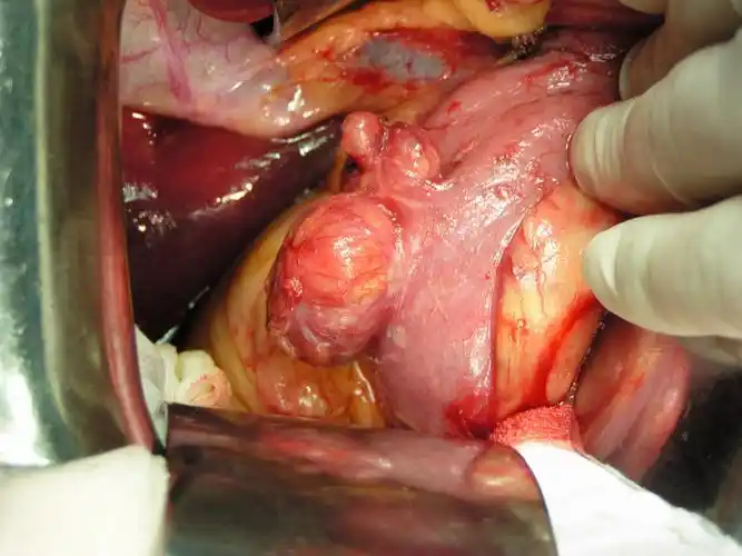 【资料】十二指肠憩室(照片)