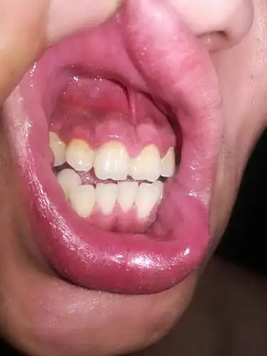 我牙床子有点黑黑的正常吗