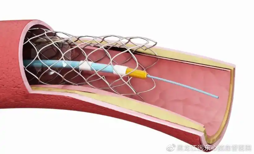 心脏支架进口国产怎么选才合适
