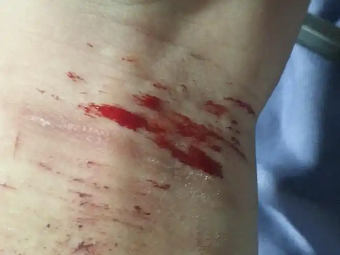 03:23:00:我的建议,您还是不要自残,自残容易感染,可以通过其他方式